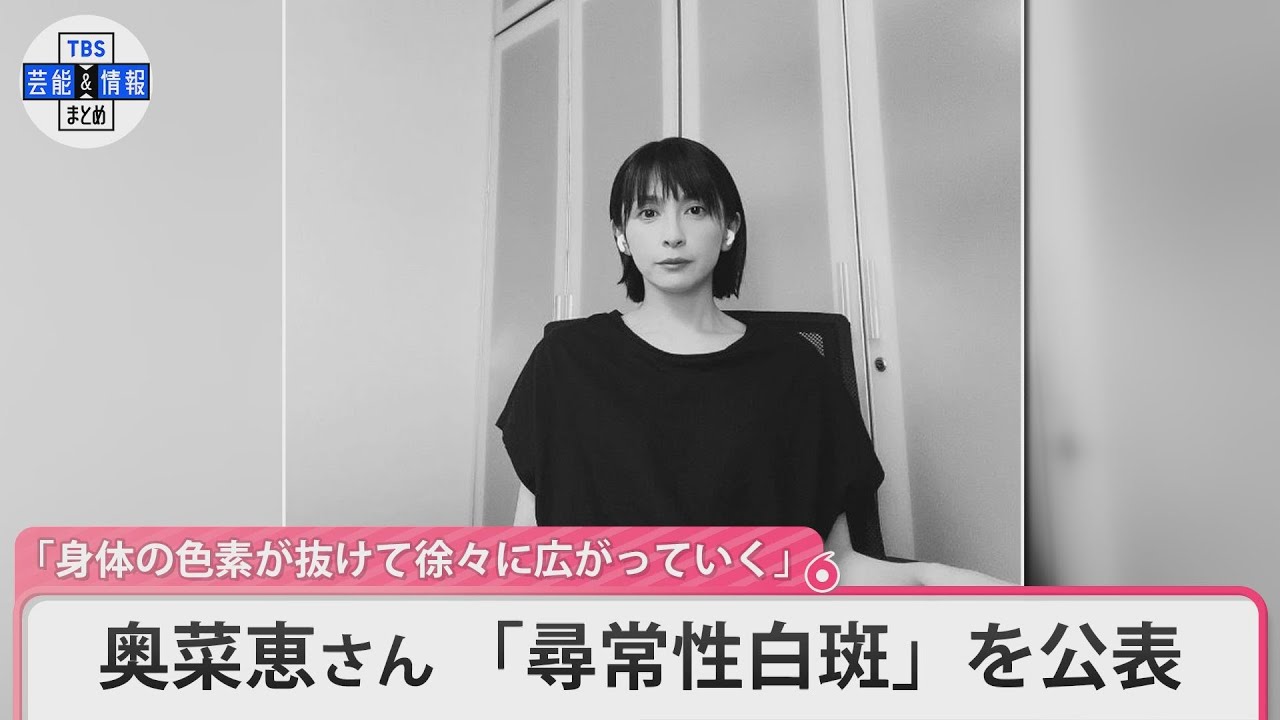 「尋常性白斑という病気」を発症したことを告白